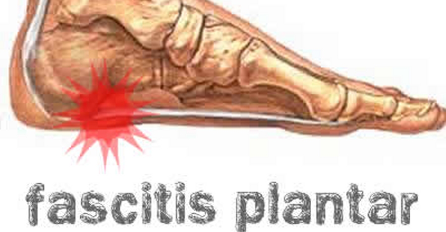 Fascitis plantar: una de les lesions ms comuns entre els corredors